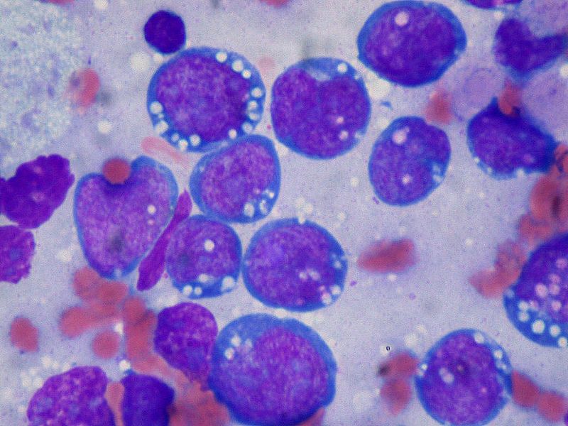 Soubor:Burkitt lymphoma, touch prep, Wright stain.jpg