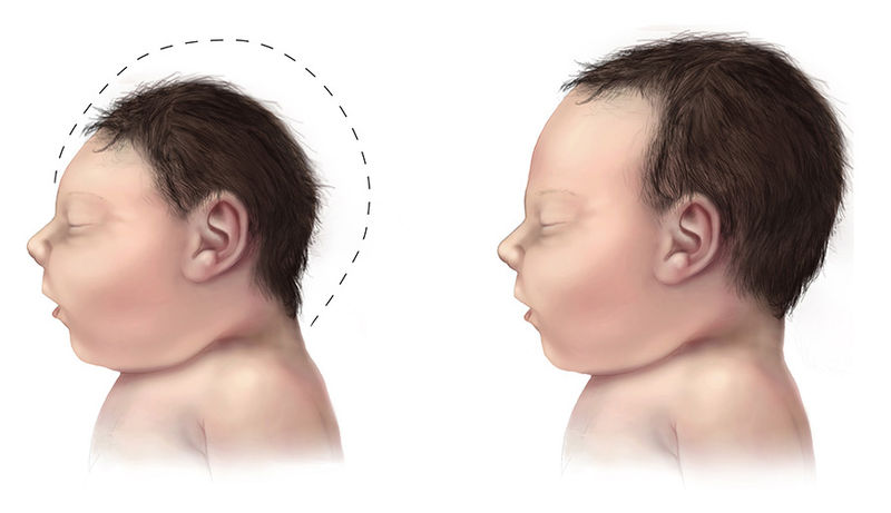 Soubor:Microcephaly-comparison-500px.jpg